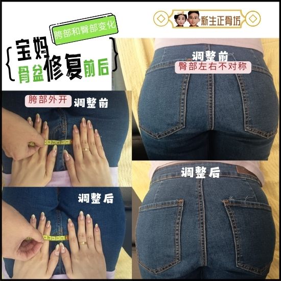 骨盆修复